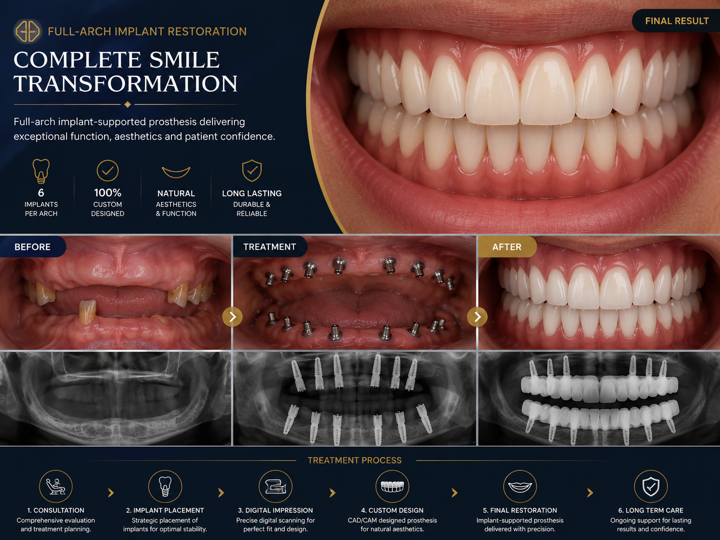 Implant Prosthetics